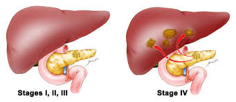 Pancreatic Cancer Treatment in Electronic City